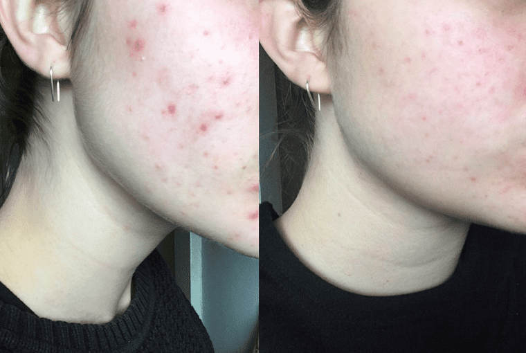Adult Acne Before and After